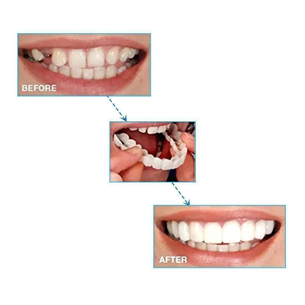 Magic Smile Teeth Brace - Image 3