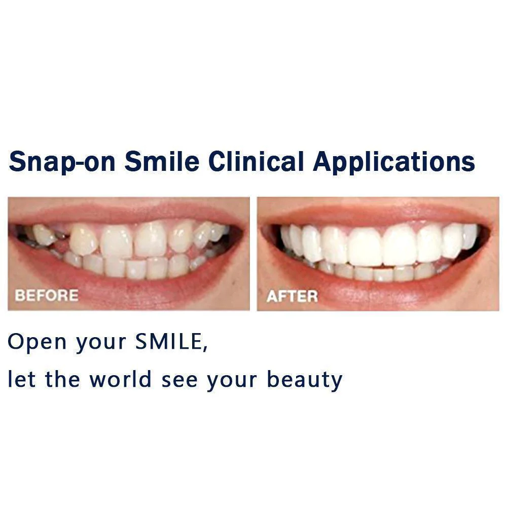 Magic Smile Teeth Brace - Image 4