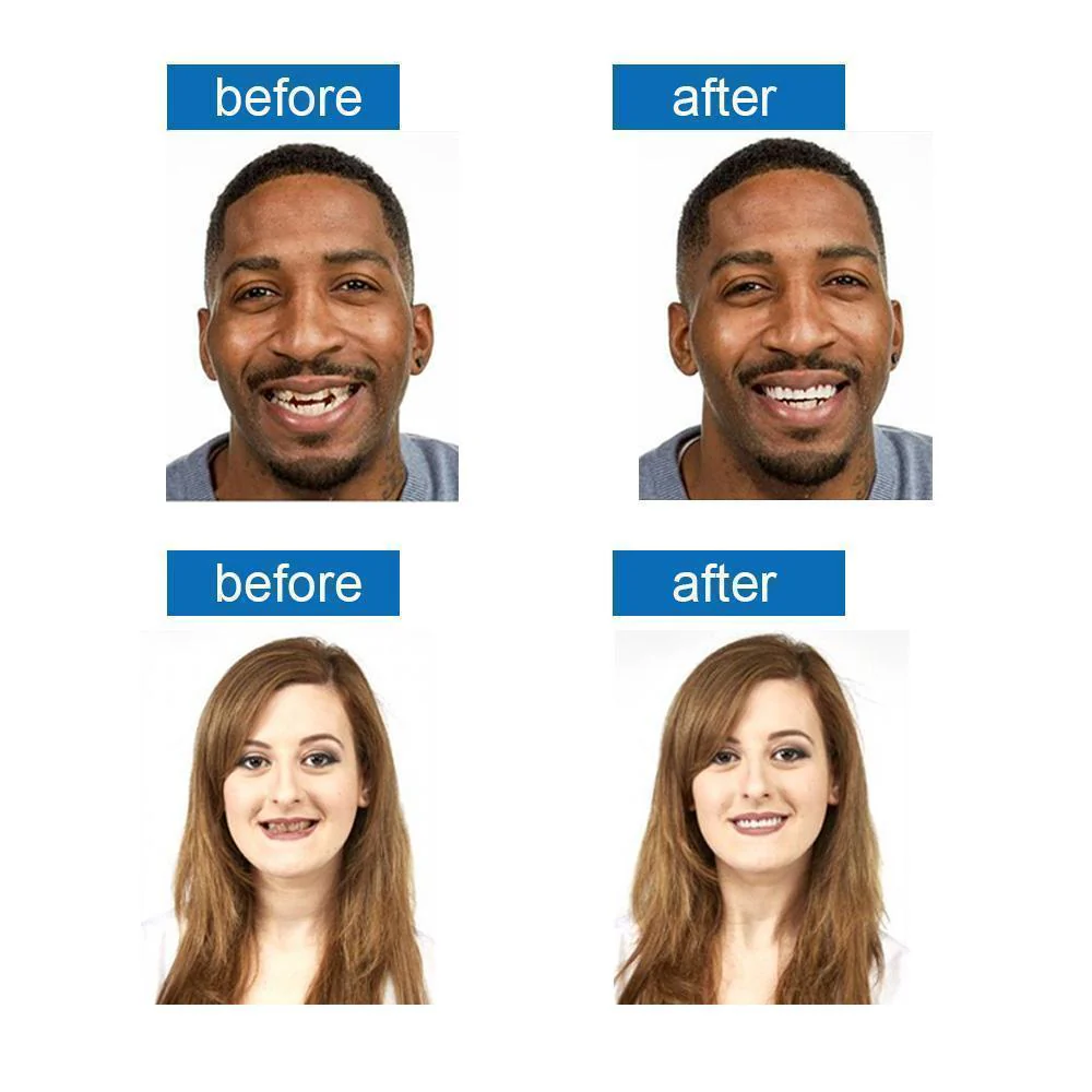 Magic Smile Teeth Brace - Image 8